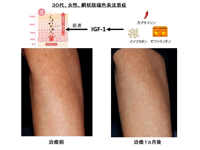 円形脱毛症　名医